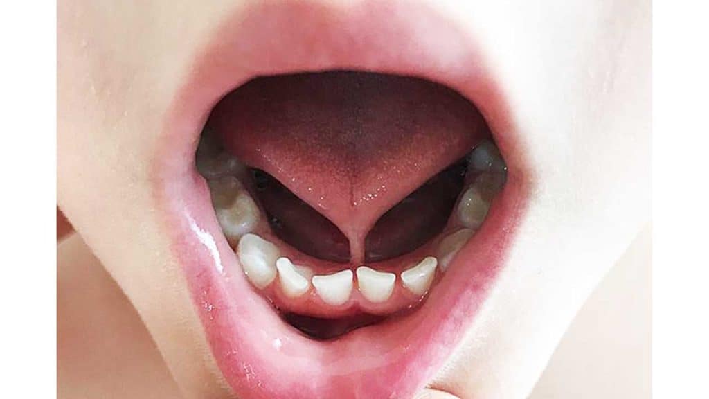 what-is-tongue-tie-ankyloglossia-problems-symptoms-treatment